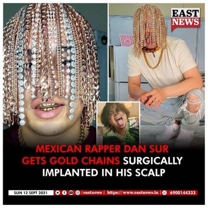 Rapper Dan Sur Gets Gold Chain Implanted Into His Head &mdash; Guardian Life